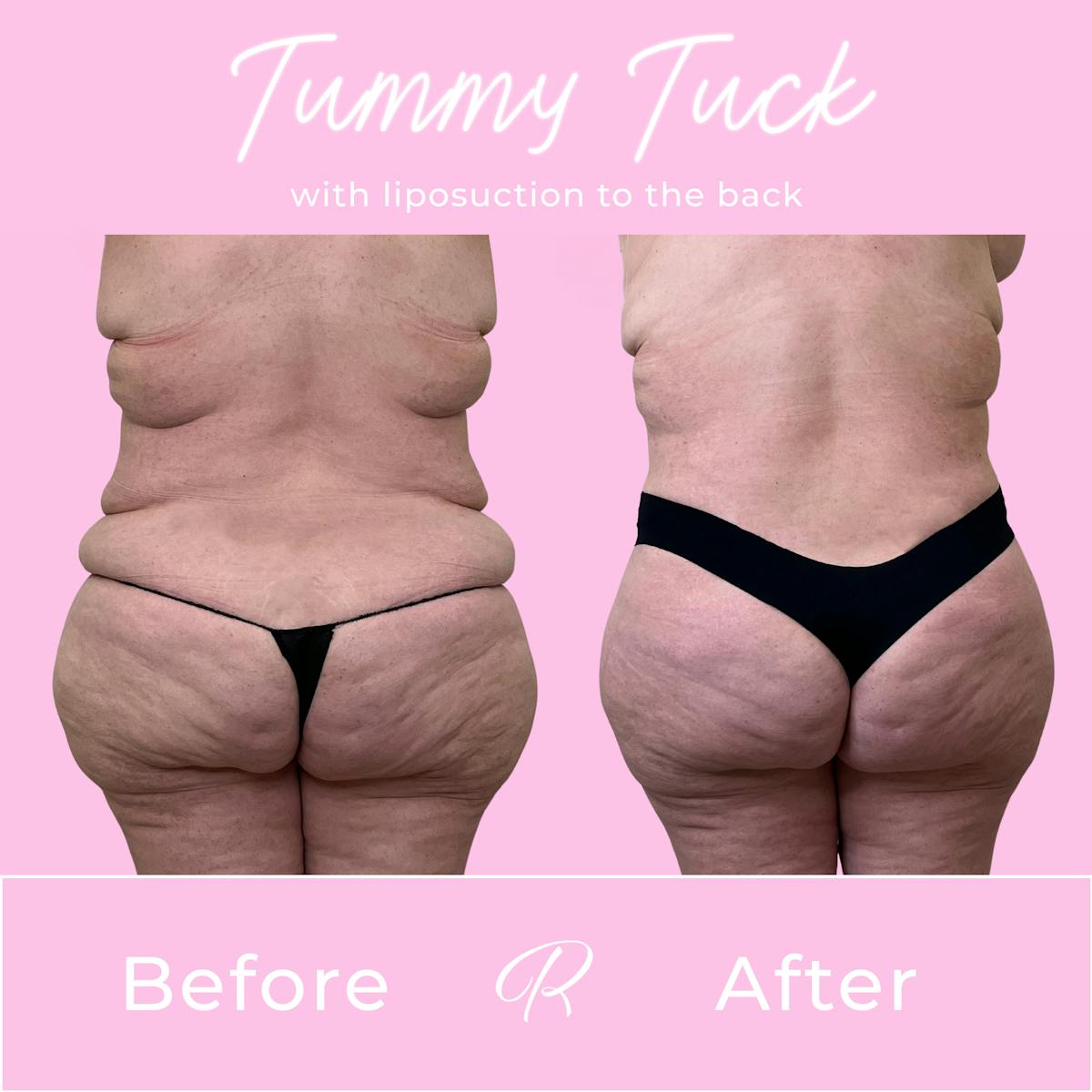 Tummy Tuck Before & After Gallery - Patient 401333 - Image 3
