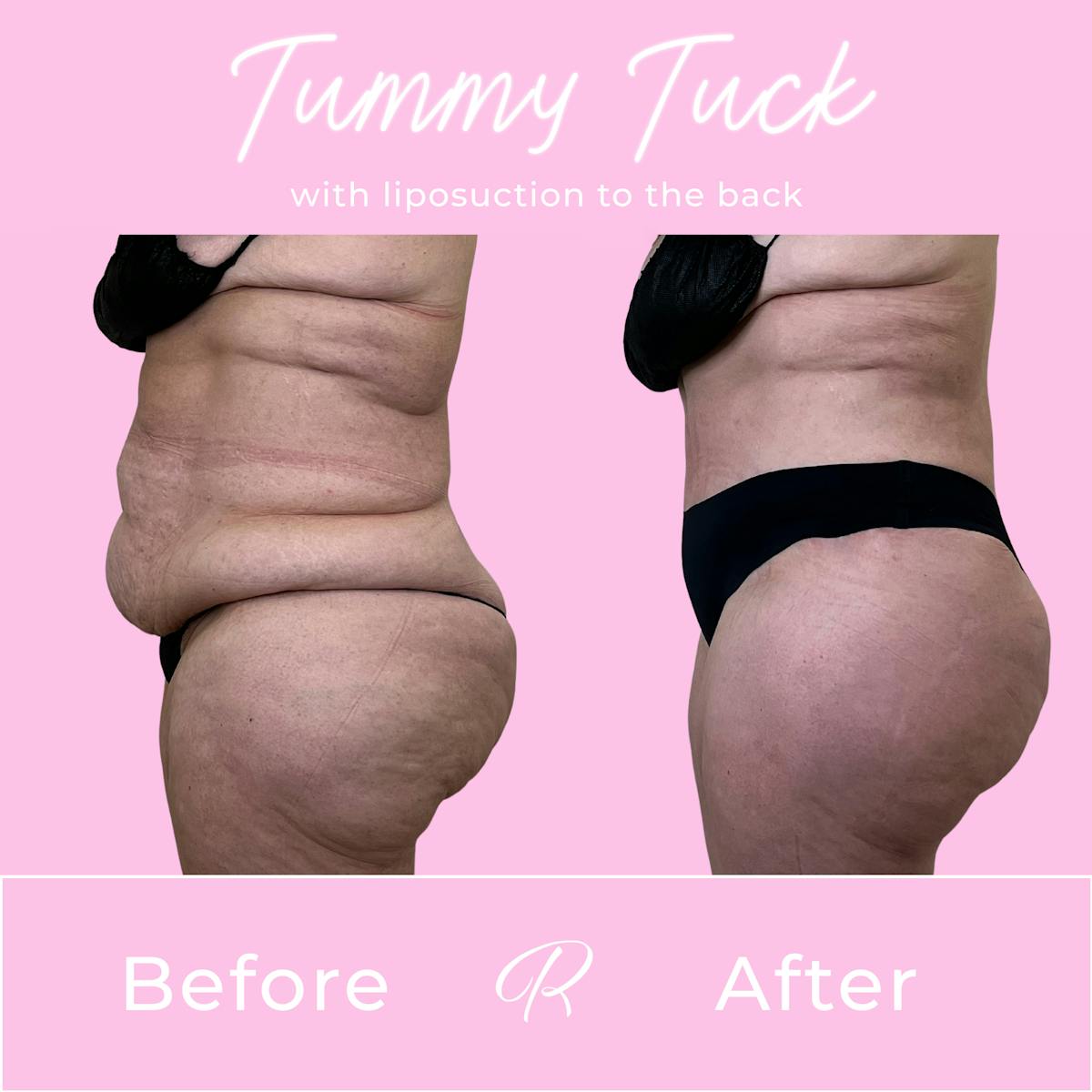 Tummy Tuck Before & After Gallery - Patient 401333 - Image 2