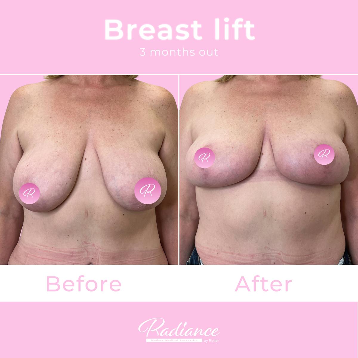 Breast Lift Before & After Gallery - Patient 348094 - Image 3
