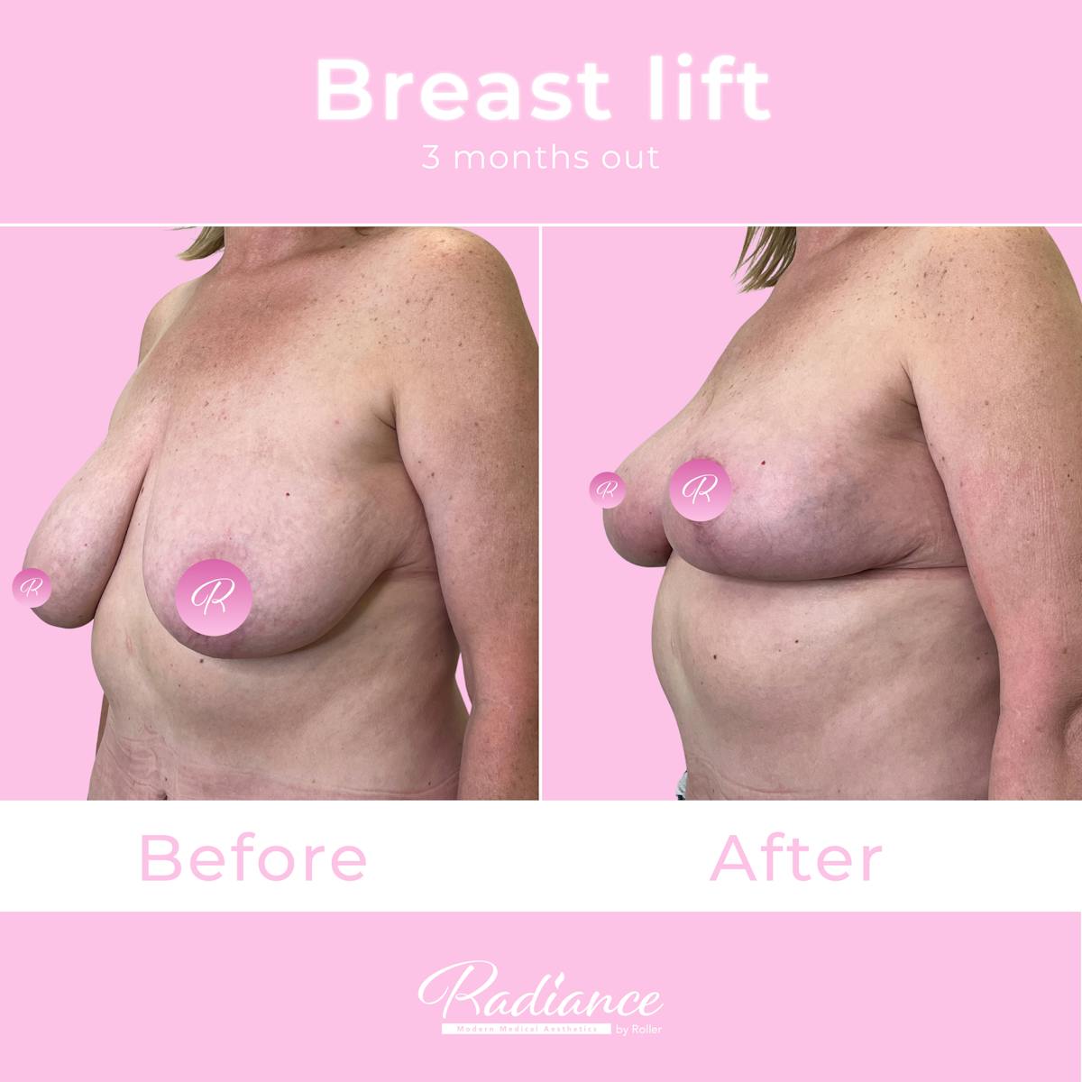 Breast Lift Before & After Gallery - Patient 348094 - Image 2