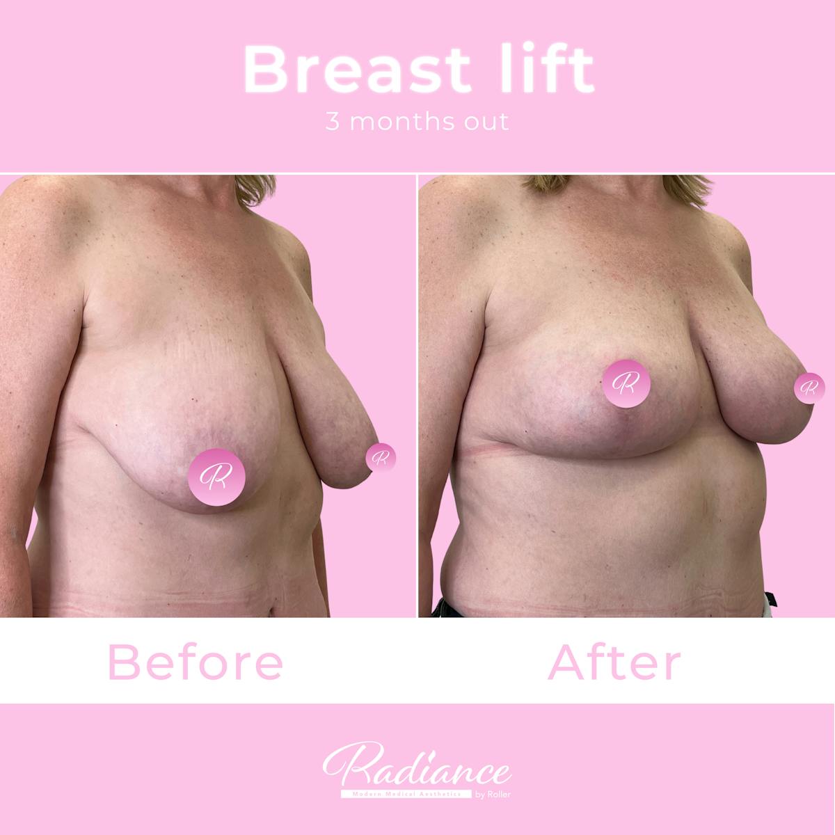 Breast Lift Before & After Gallery - Patient 348094 - Image 4