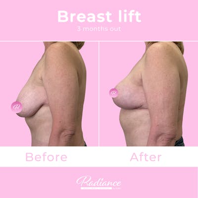 Breast Lift Before & After Gallery - Patient 348094 - Image 1
