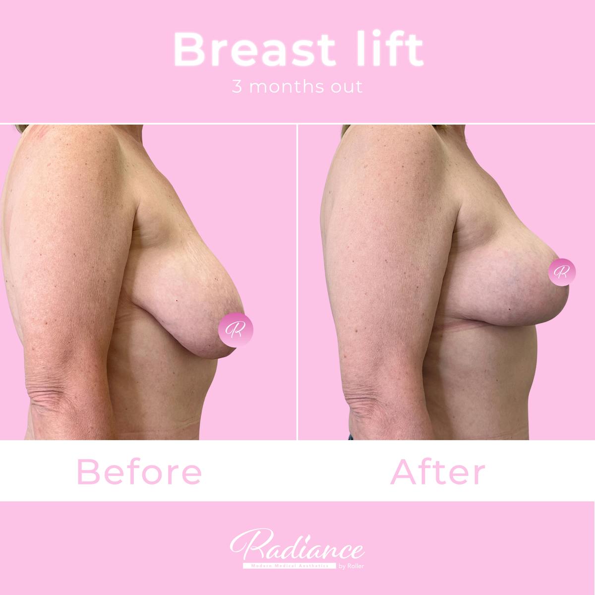 Breast Lift Before & After Gallery - Patient 348094 - Image 5