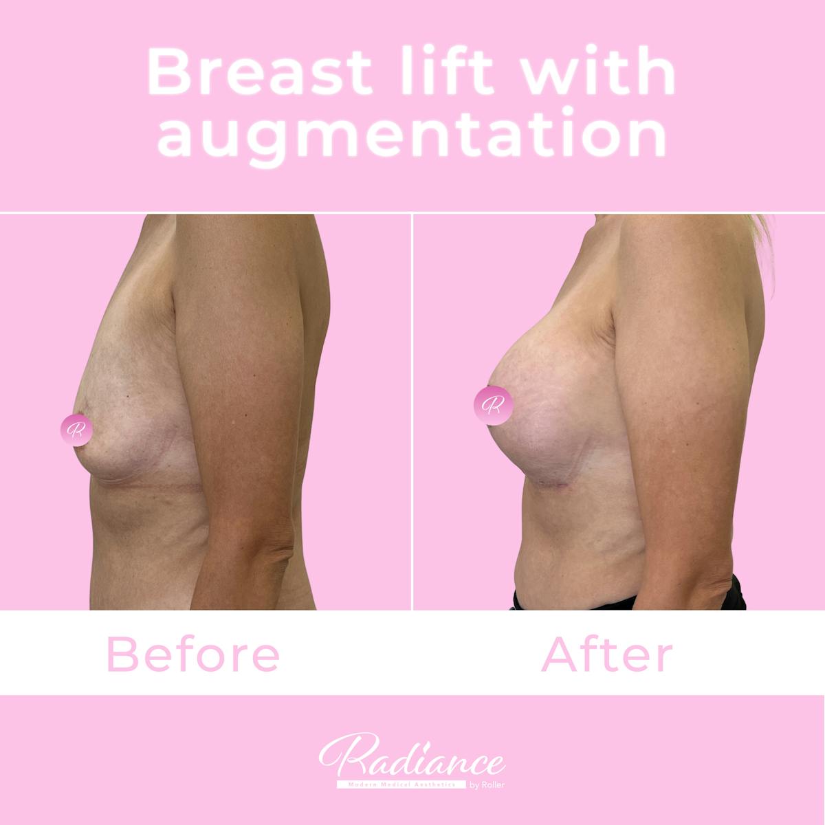 Breast Lift With Augmentation Before & After Gallery - Patient 176368 - Image 4