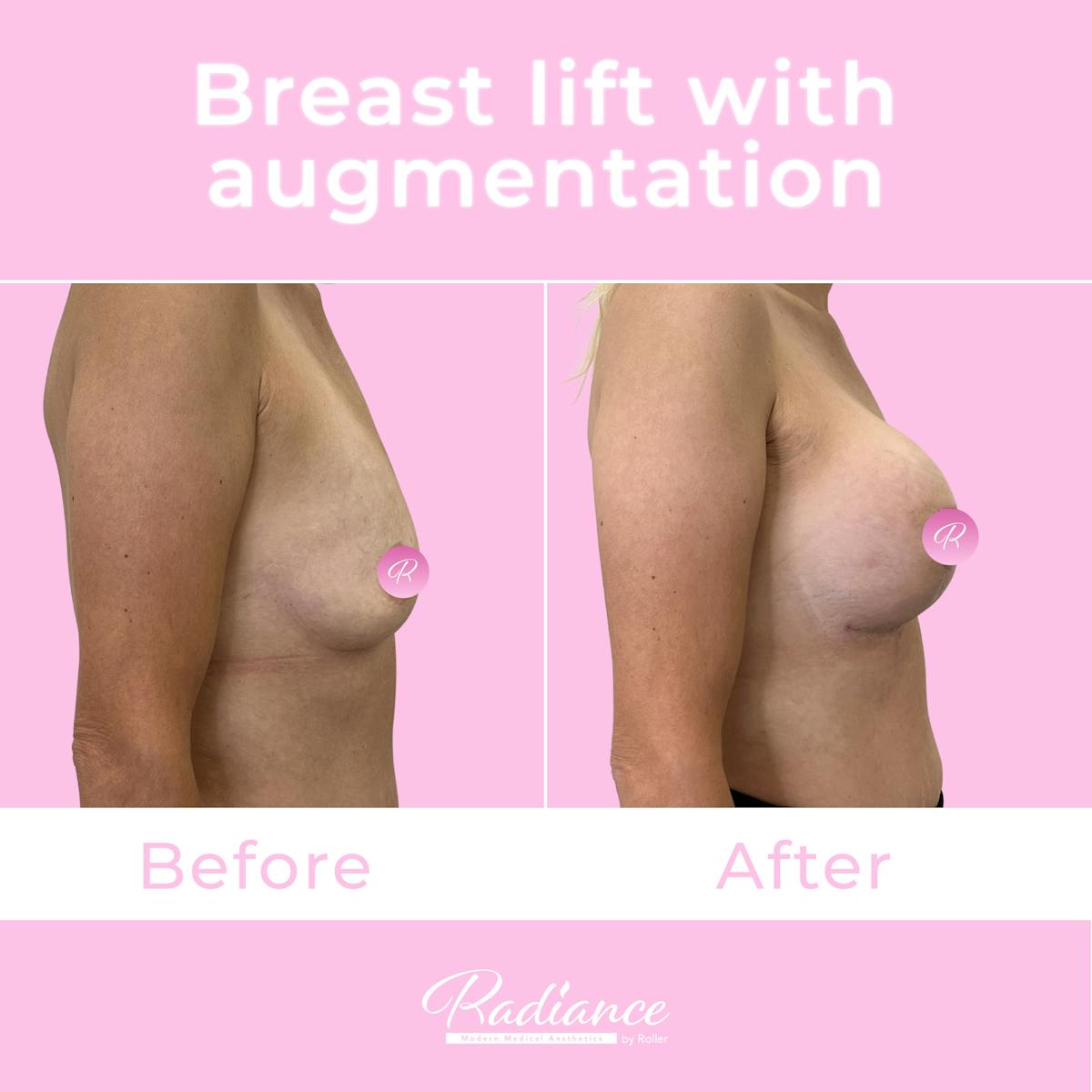 Breast Lift With Augmentation Before & After Gallery - Patient 176368 - Image 5