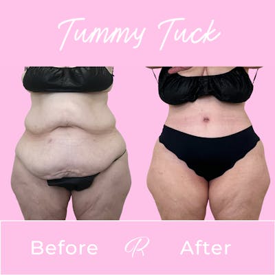 Tummy Tuck Before & After Gallery - Patient 402296 - Image 1