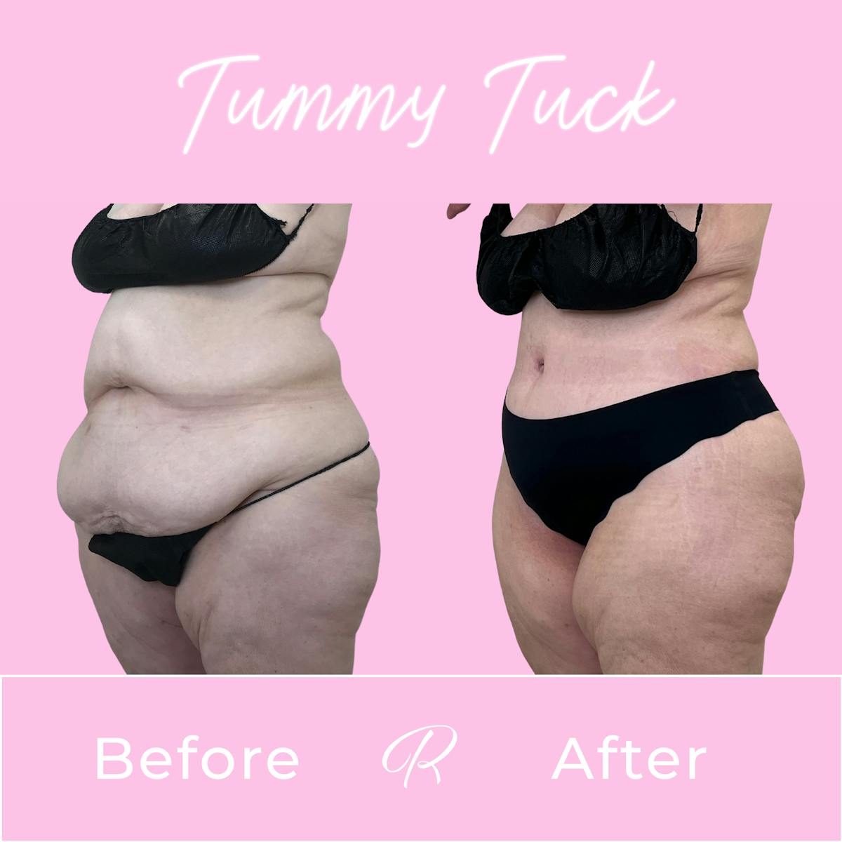 Tummy Tuck Before & After Gallery - Patient 402296 - Image 2