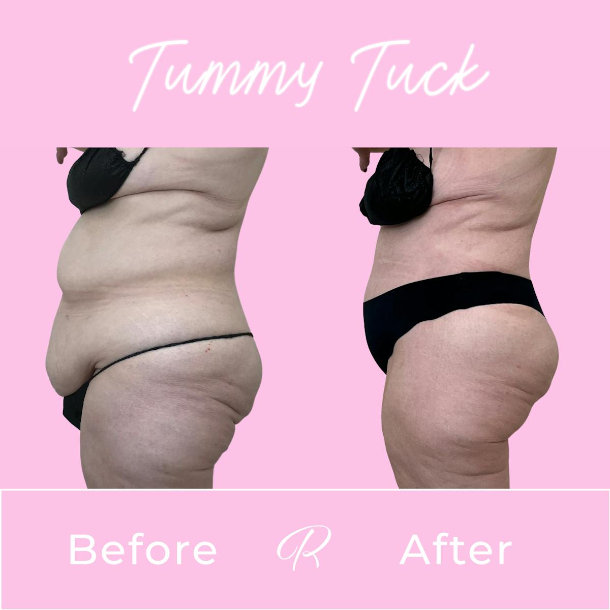 Tummy Tuck Before & After Gallery - Patient 402296 - Image 3