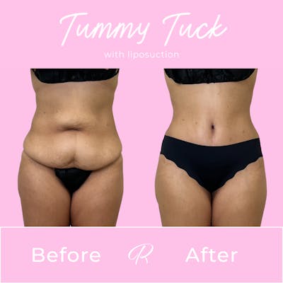 Tummy Tuck Before & After Gallery - Patient 331695 - Image 1