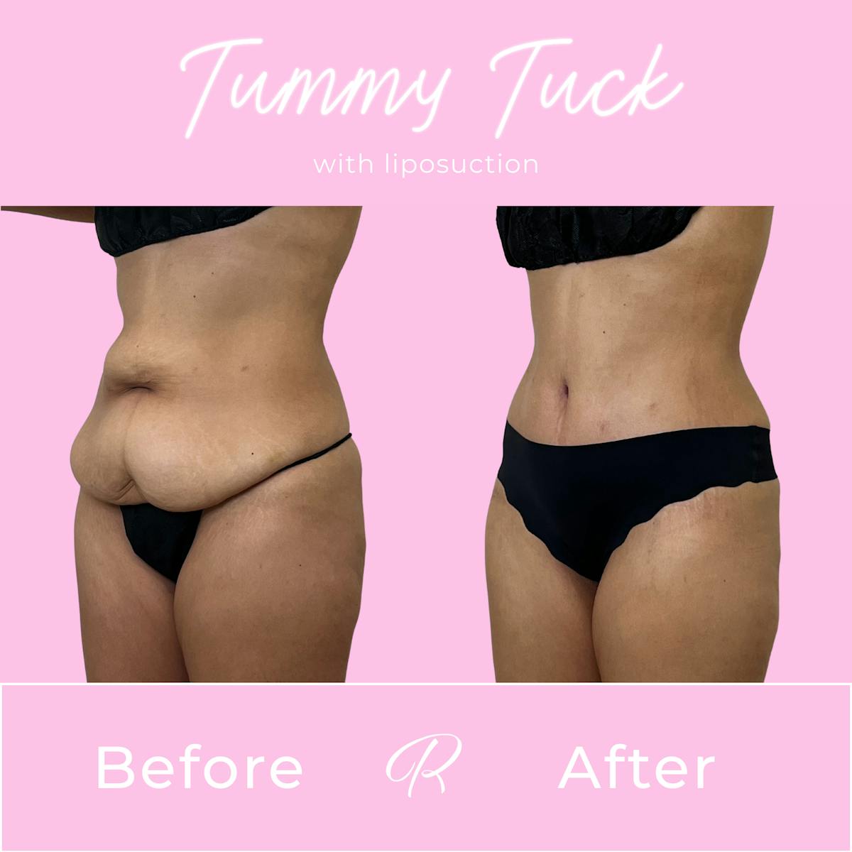 Tummy Tuck Before & After Gallery - Patient 331695 - Image 2