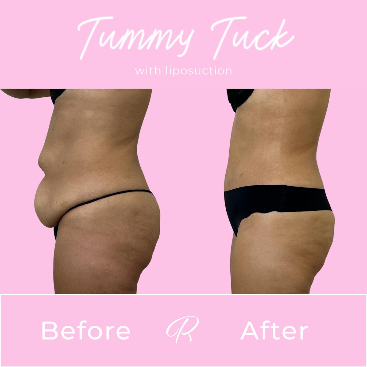 Tummy Tuck Before & After Gallery - Patient 331695 - Image 3