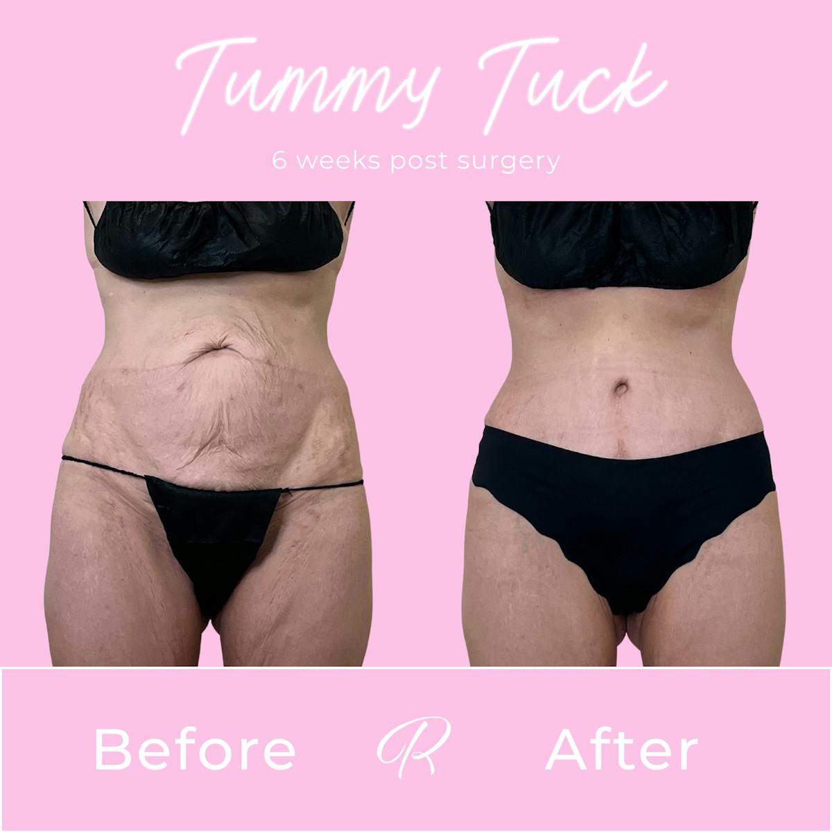 Tummy Tuck Before & After Gallery - Patient 540235 - Image 1