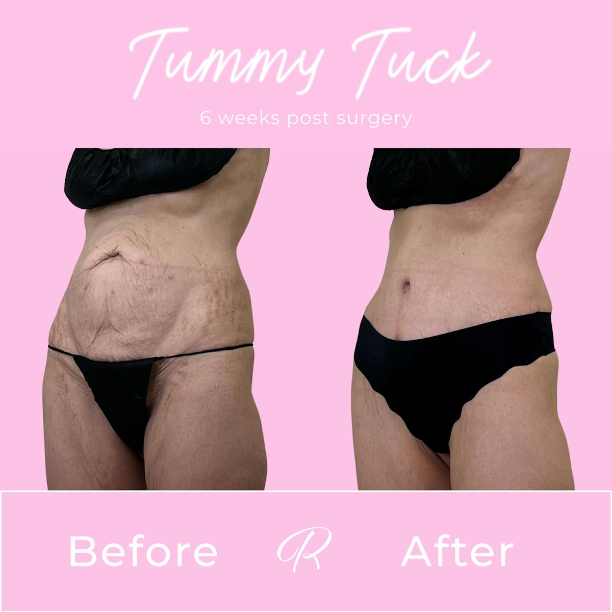 Tummy Tuck Before & After Gallery - Patient 540235 - Image 2