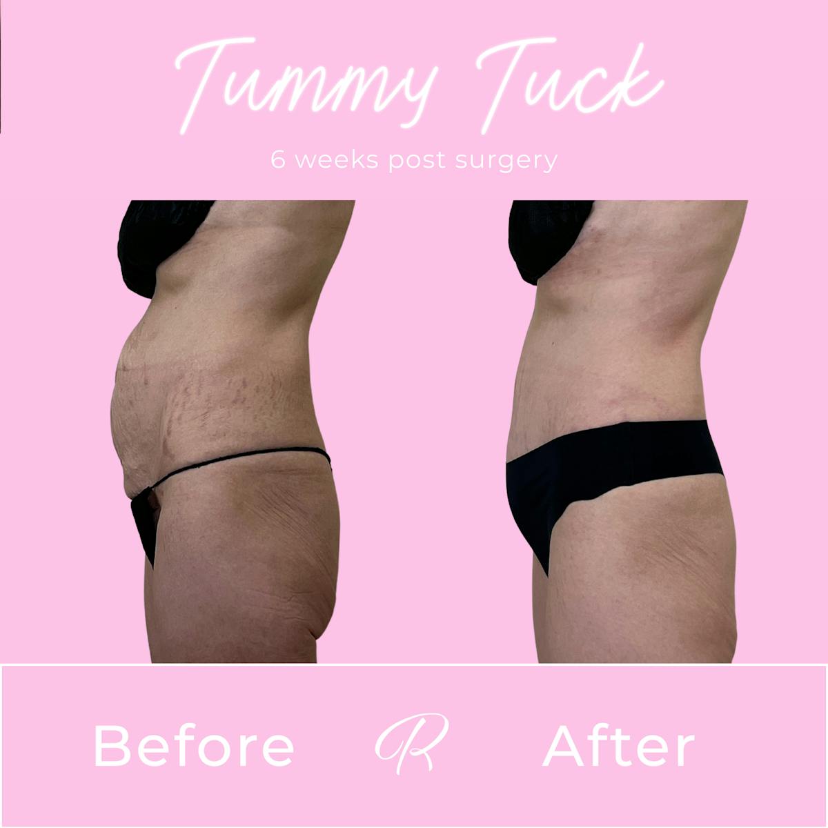 Tummy Tuck Before & After Gallery - Patient 540235 - Image 3