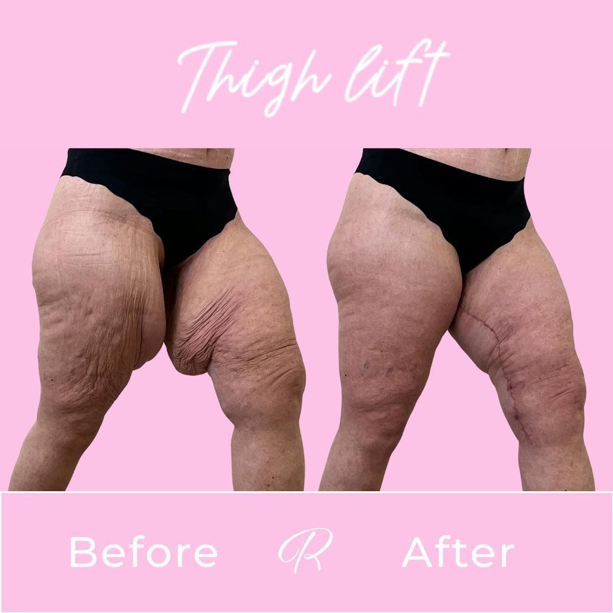 Thigh Lift Before & After Gallery - Patient 428523 - Image 2