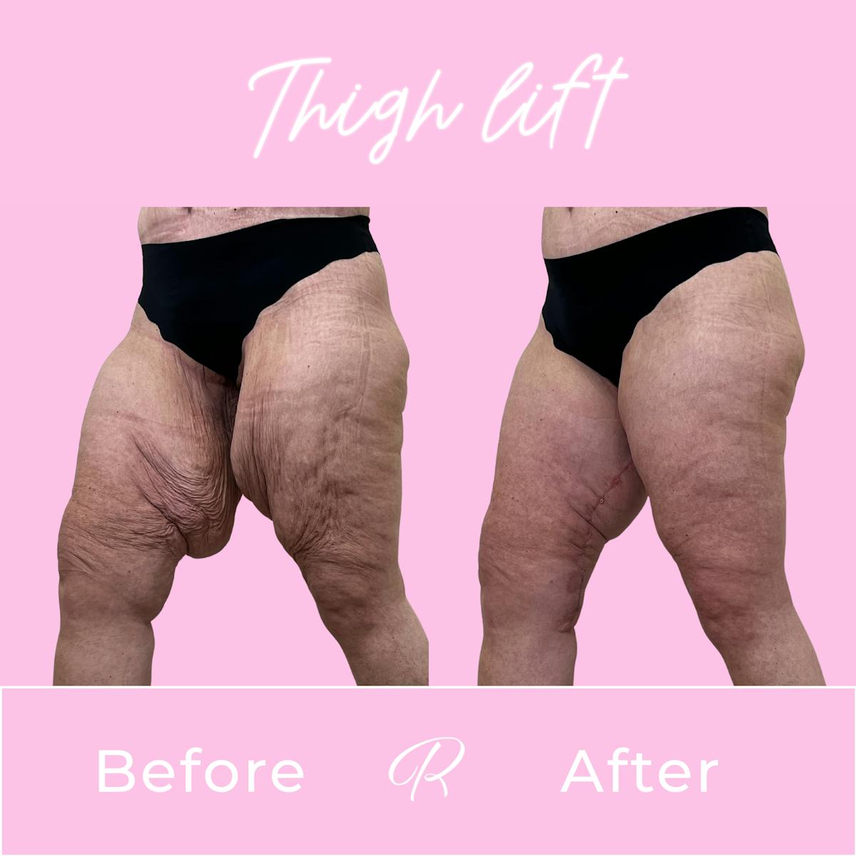 Thigh Lift Before & After Gallery - Patient 428523 - Image 3