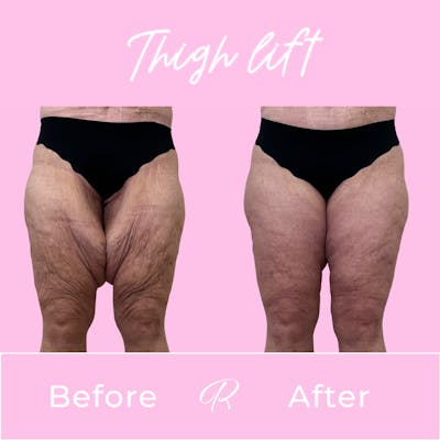 Thigh Lift Before & After Gallery - Patient 428523 - Image 1