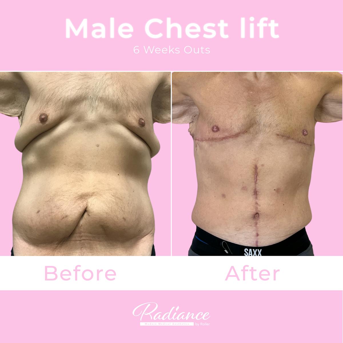 Male Chest Lift Before & After Gallery - Patient 643308 - Image 1