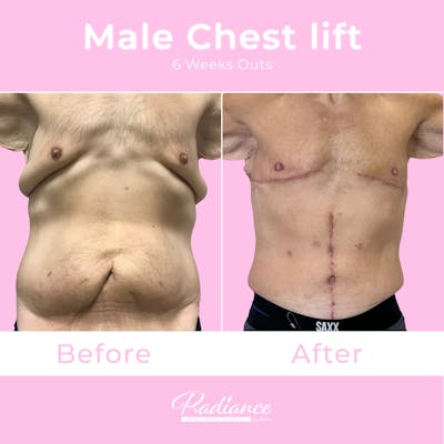 Male Chest Lift Before & After Gallery - Patient 643308 - Image 1