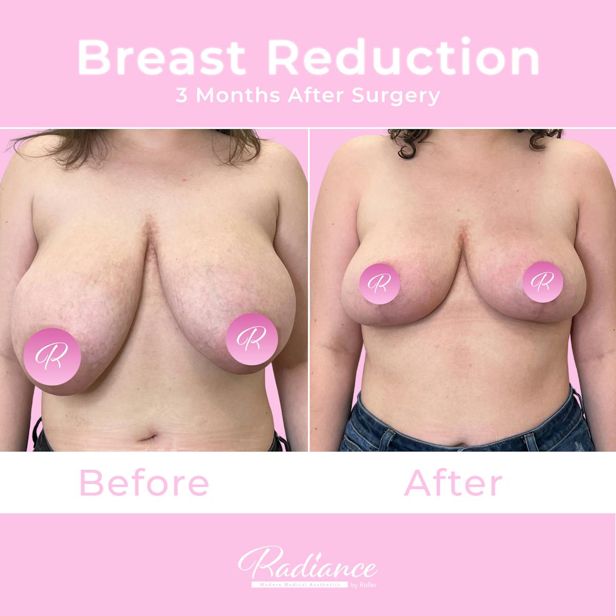 Breast Reduction Before & After Gallery - Patient 357688 - Image 1