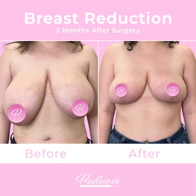 Breast Reduction Before & After Gallery - Patient 357688 - Image 1