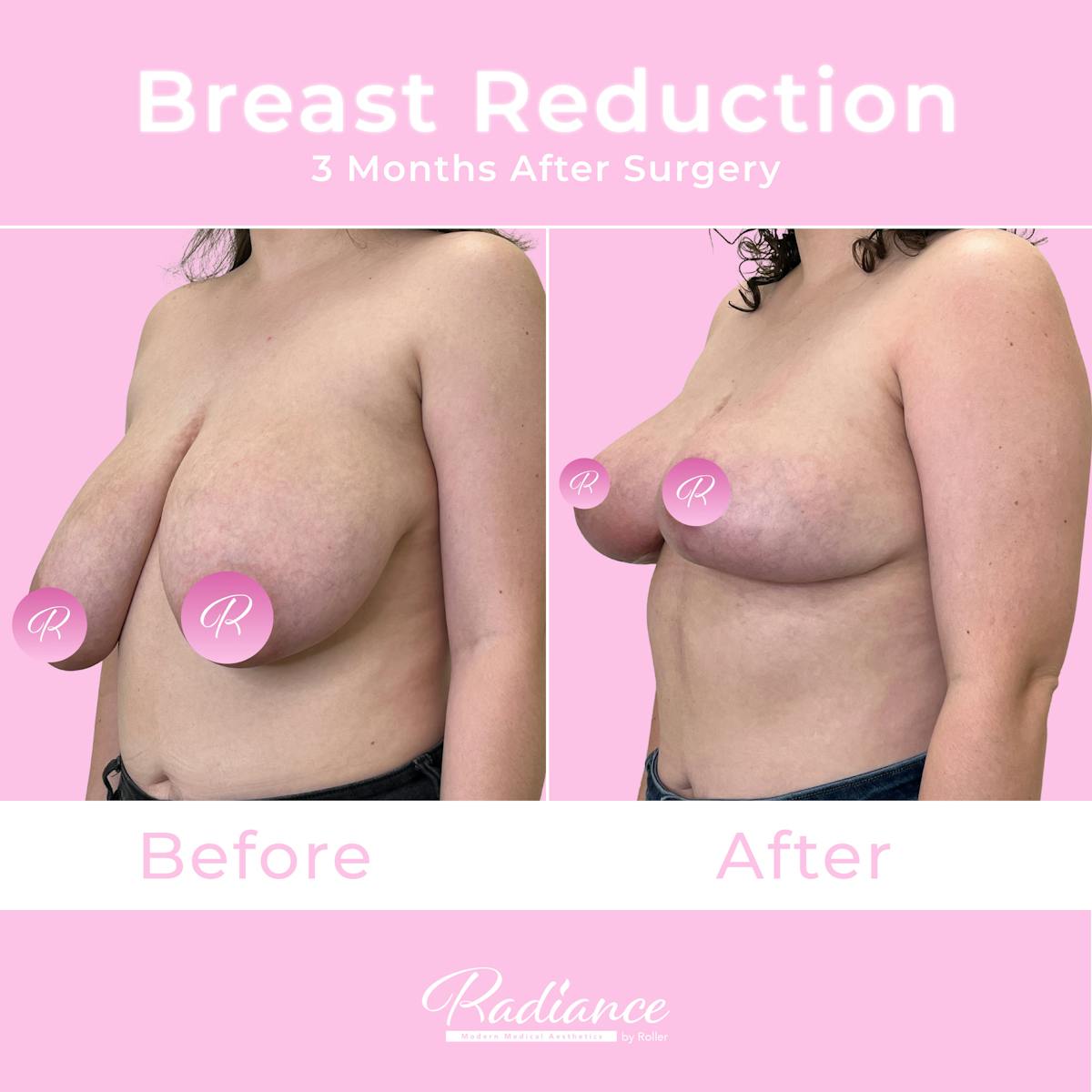 Breast Reduction Before & After Gallery - Patient 357688 - Image 2