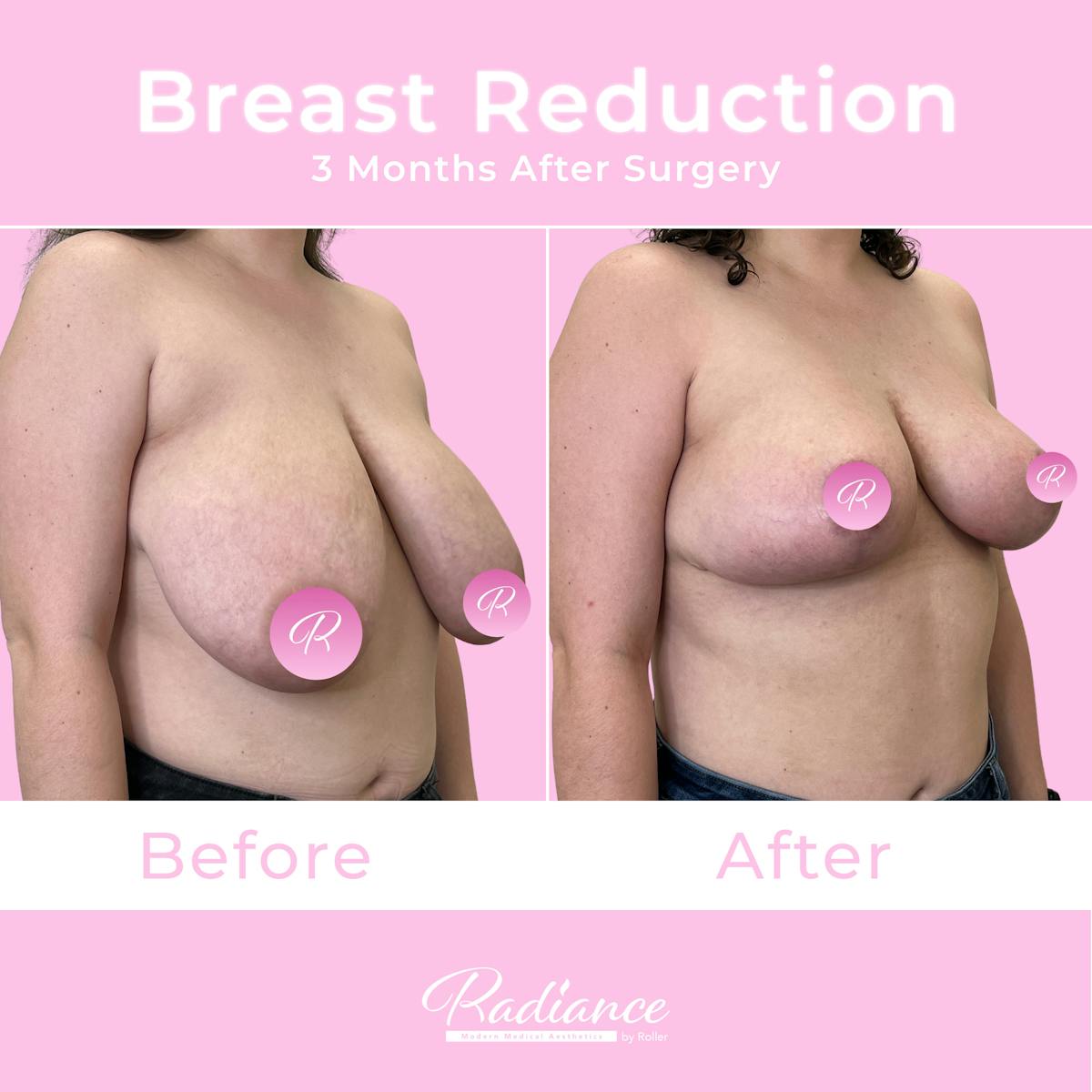 Breast Reduction Before & After Gallery - Patient 357688 - Image 3