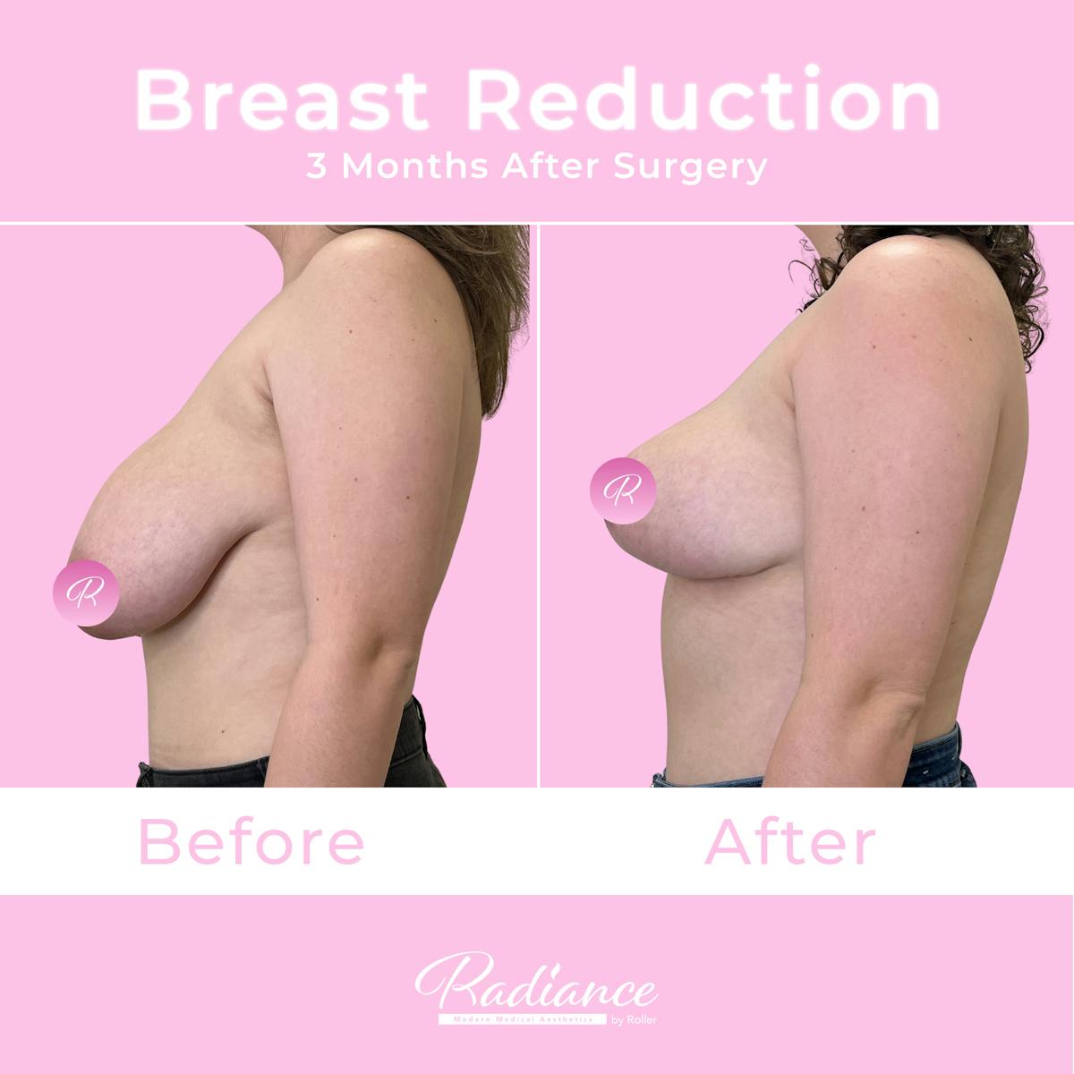 Breast Reduction Before & After Gallery - Patient 357688 - Image 4