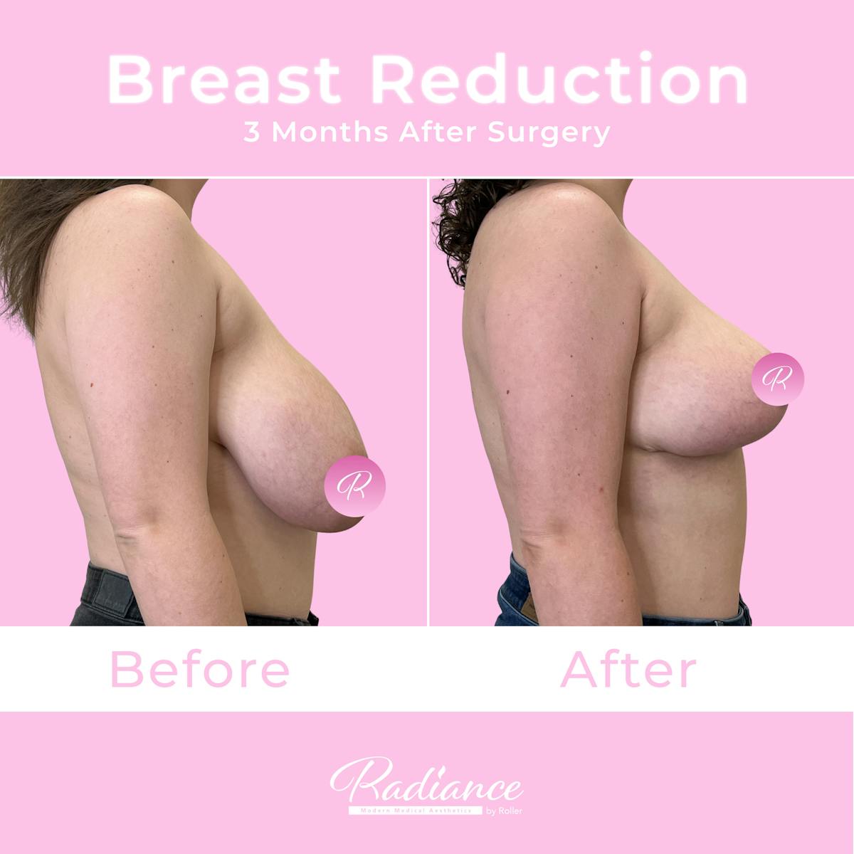 Breast Reduction Before & After Gallery - Patient 357688 - Image 5