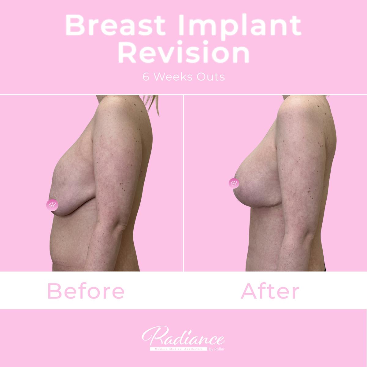 Breast Implant Revision Before & After Gallery - Patient 292546 - Image 3