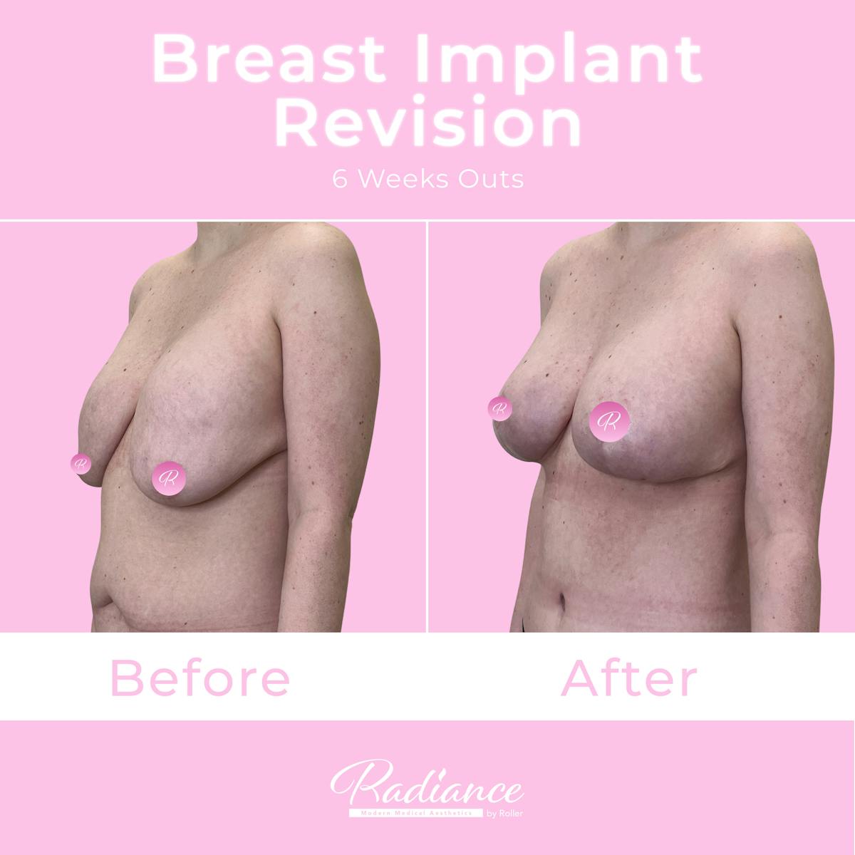 Breast Implant Revision Before & After Gallery - Patient 292546 - Image 2