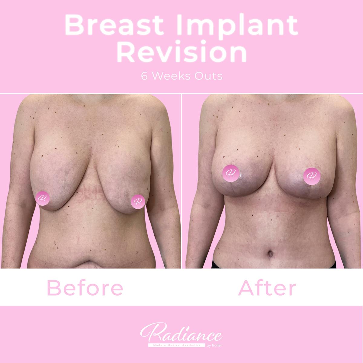 Breast Implant Revision Before & After Gallery - Patient 292546 - Image 1
