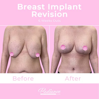 Breast Implant Revision Before & After Gallery - Patient 292546 - Image 1