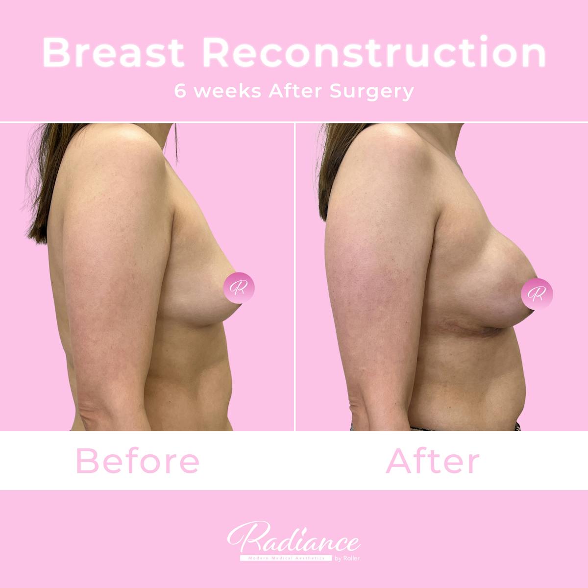 Breast Reconstruction Before & After Gallery - Patient 575247 - Image 3