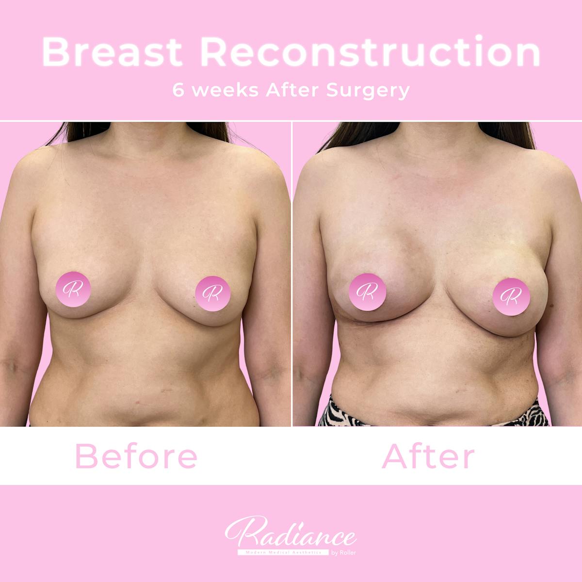 Breast Reconstruction Before & After Gallery - Patient 575247 - Image 1