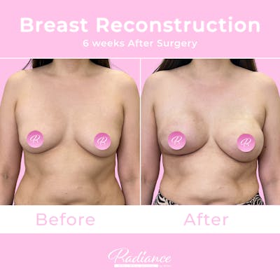 Breast Reconstruction Before & After Gallery - Patient 575247 - Image 1
