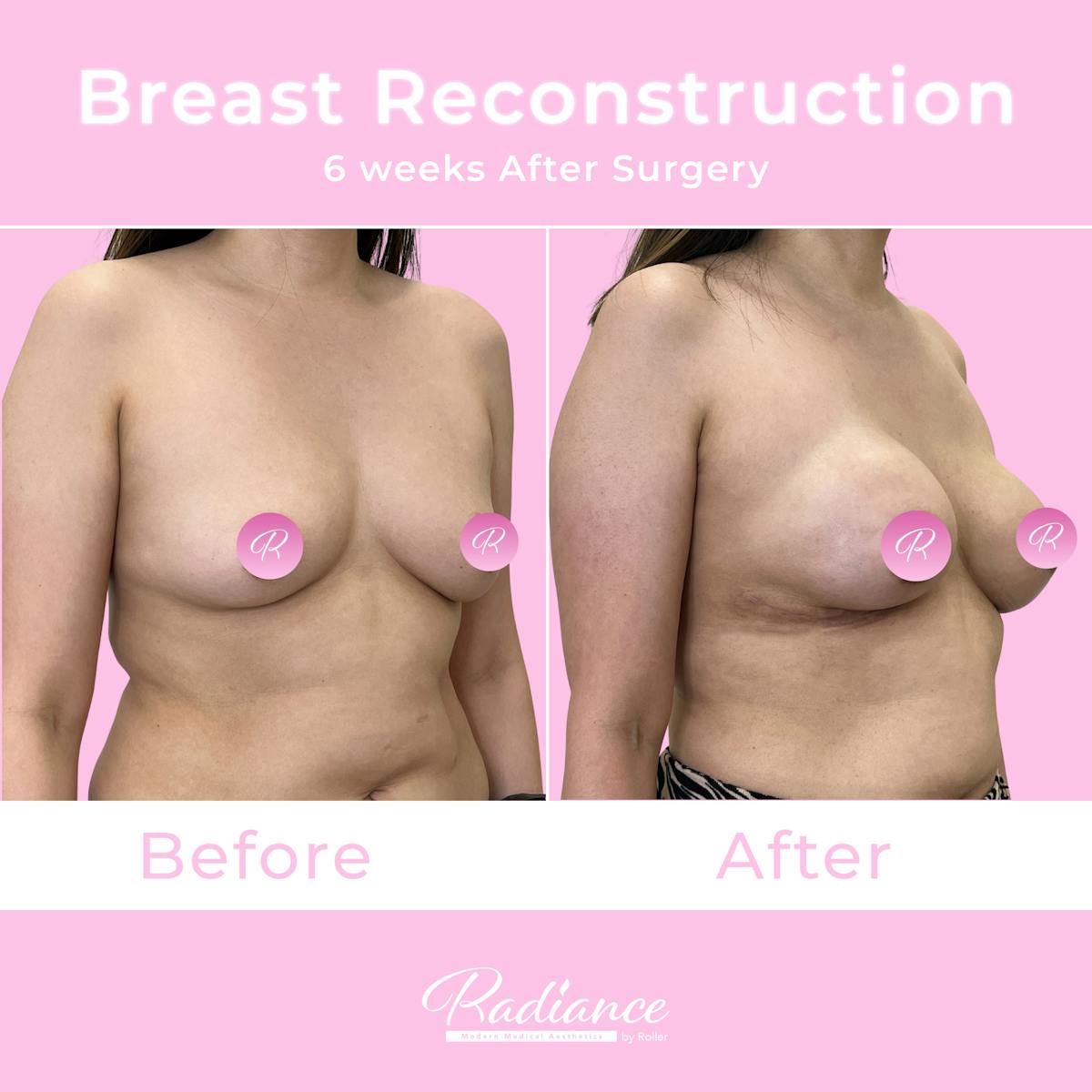 Breast Reconstruction Before & After Gallery - Patient 575247 - Image 2
