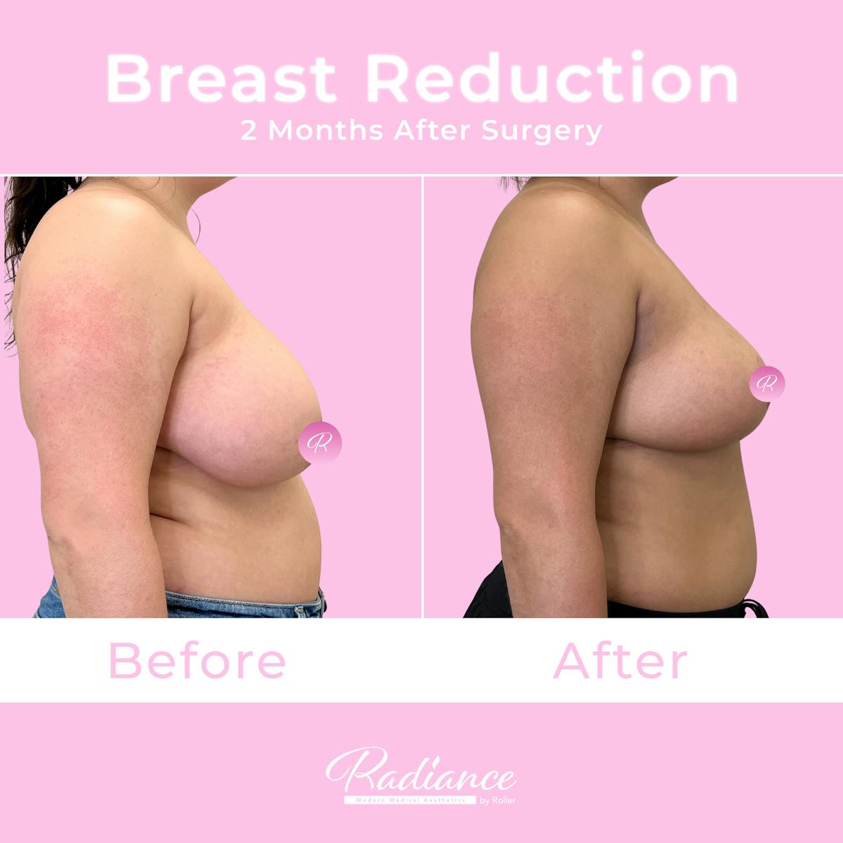Breast Reduction Before & After Gallery - Patient 167907 - Image 3