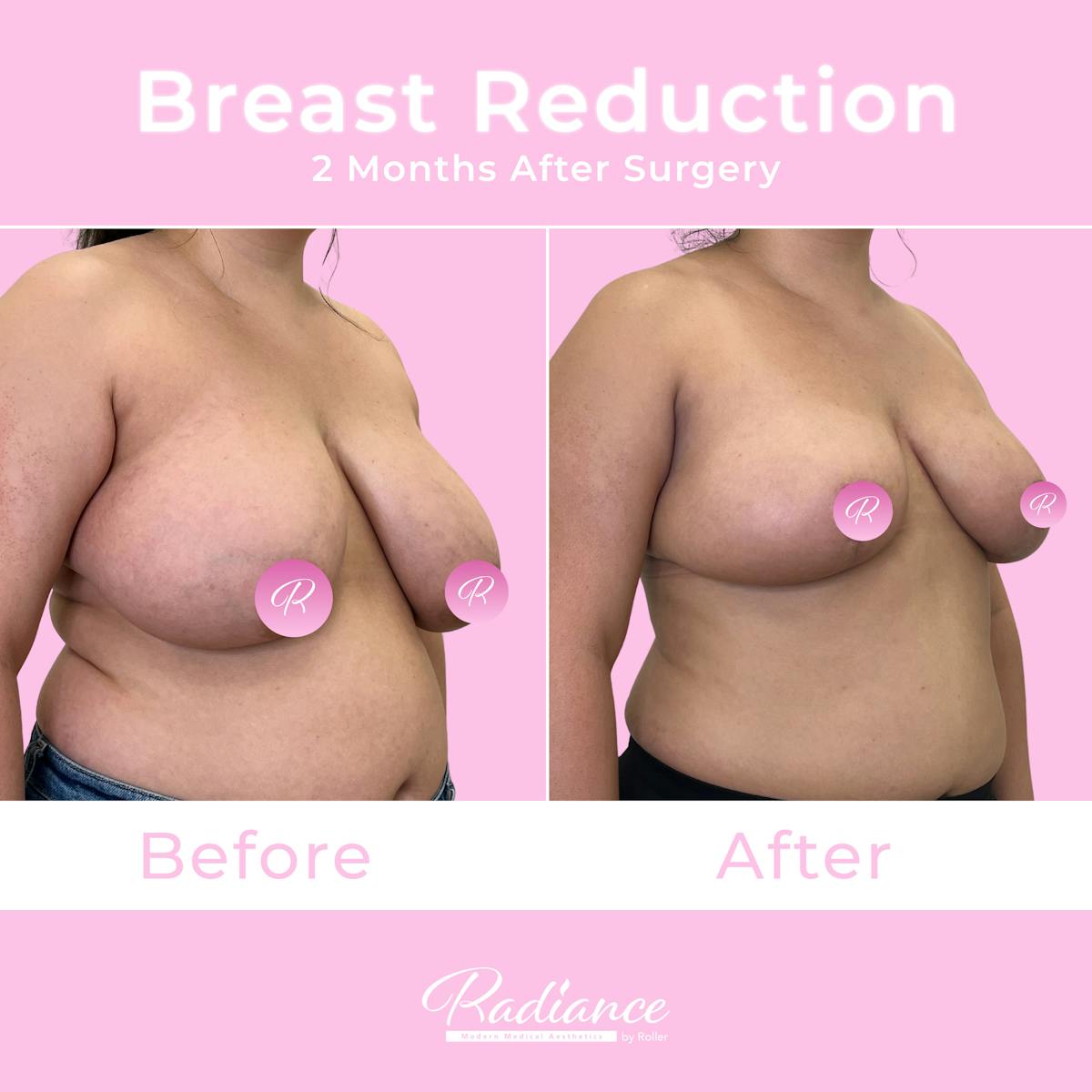 Breast Reduction Before & After Gallery - Patient 167907 - Image 2