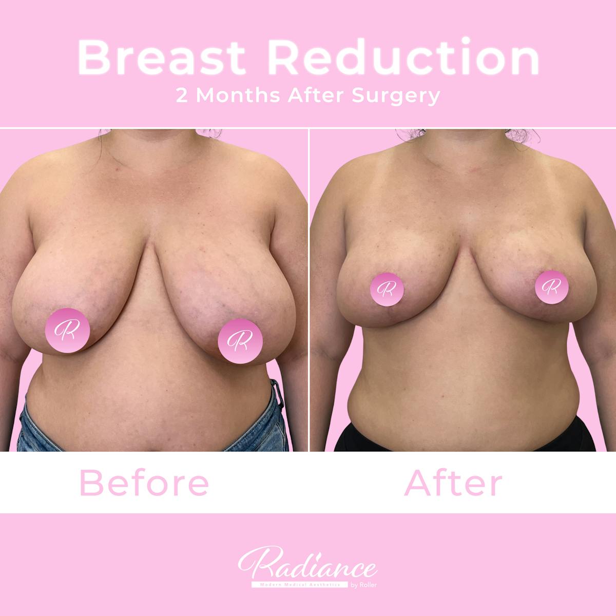 Breast Reduction Before & After Gallery - Patient 167907 - Image 1