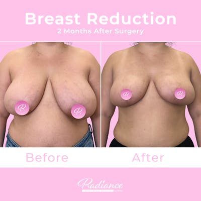 Breast Reduction Before & After Gallery - Patient 167907 - Image 1