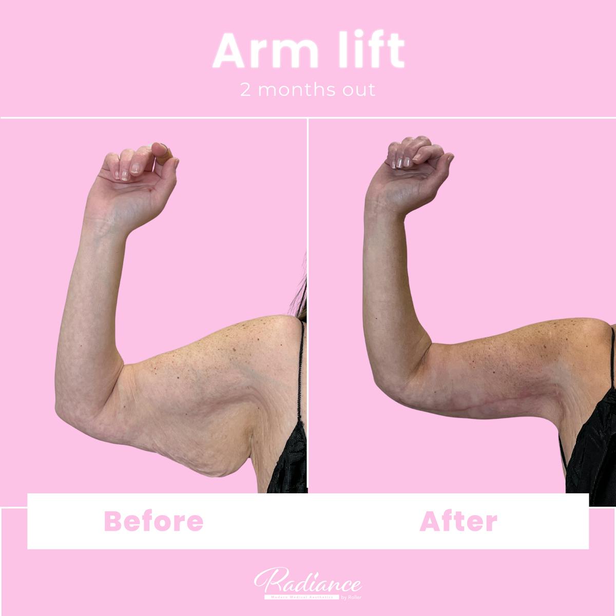 Arm Lift Before & After Gallery - Patient 411982 - Image 1