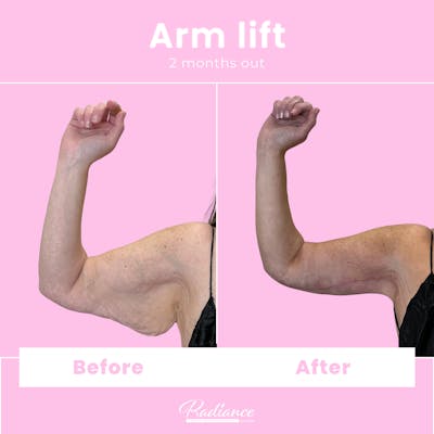 Arm Lift Before & After Gallery - Patient 411982 - Image 1