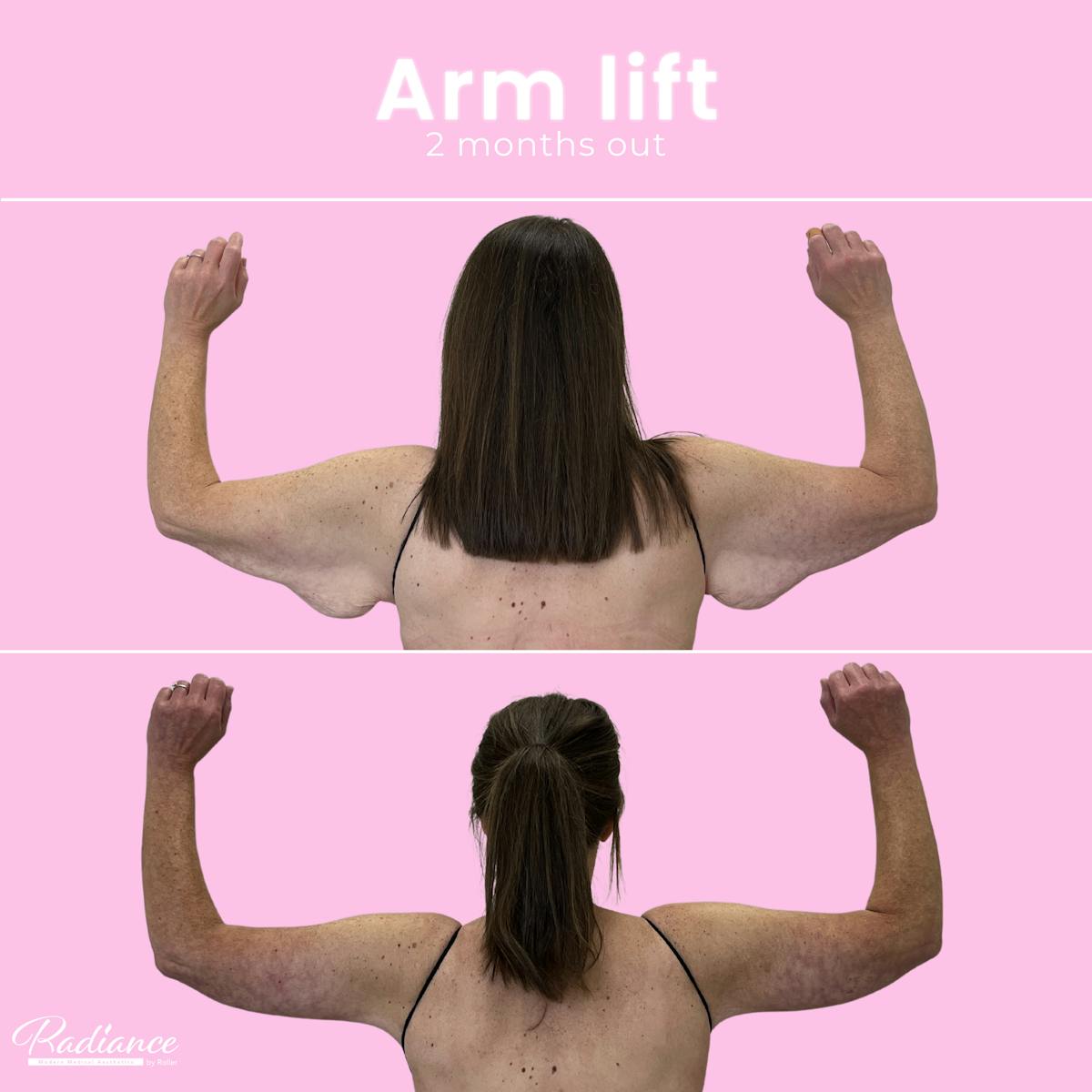 Arm Lift Before & After Gallery - Patient 411982 - Image 2