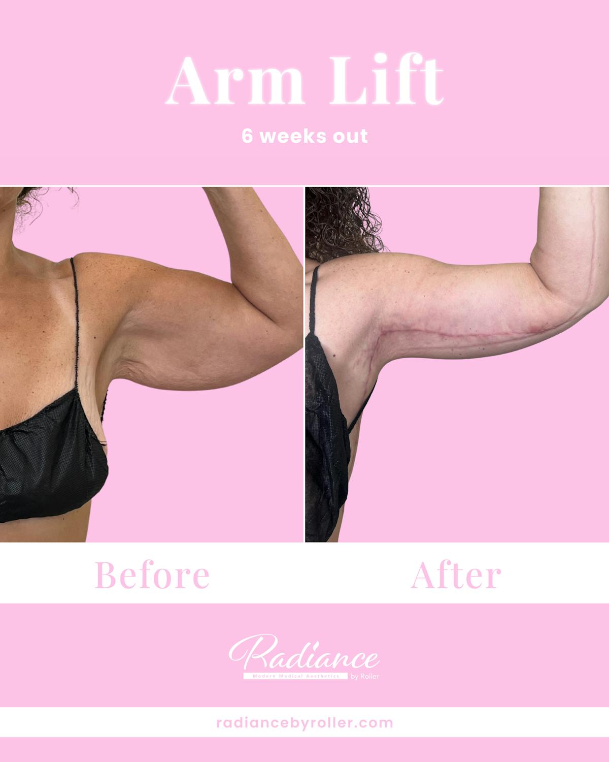 Arm Lift Before & After Gallery - Patient 211635 - Image 3