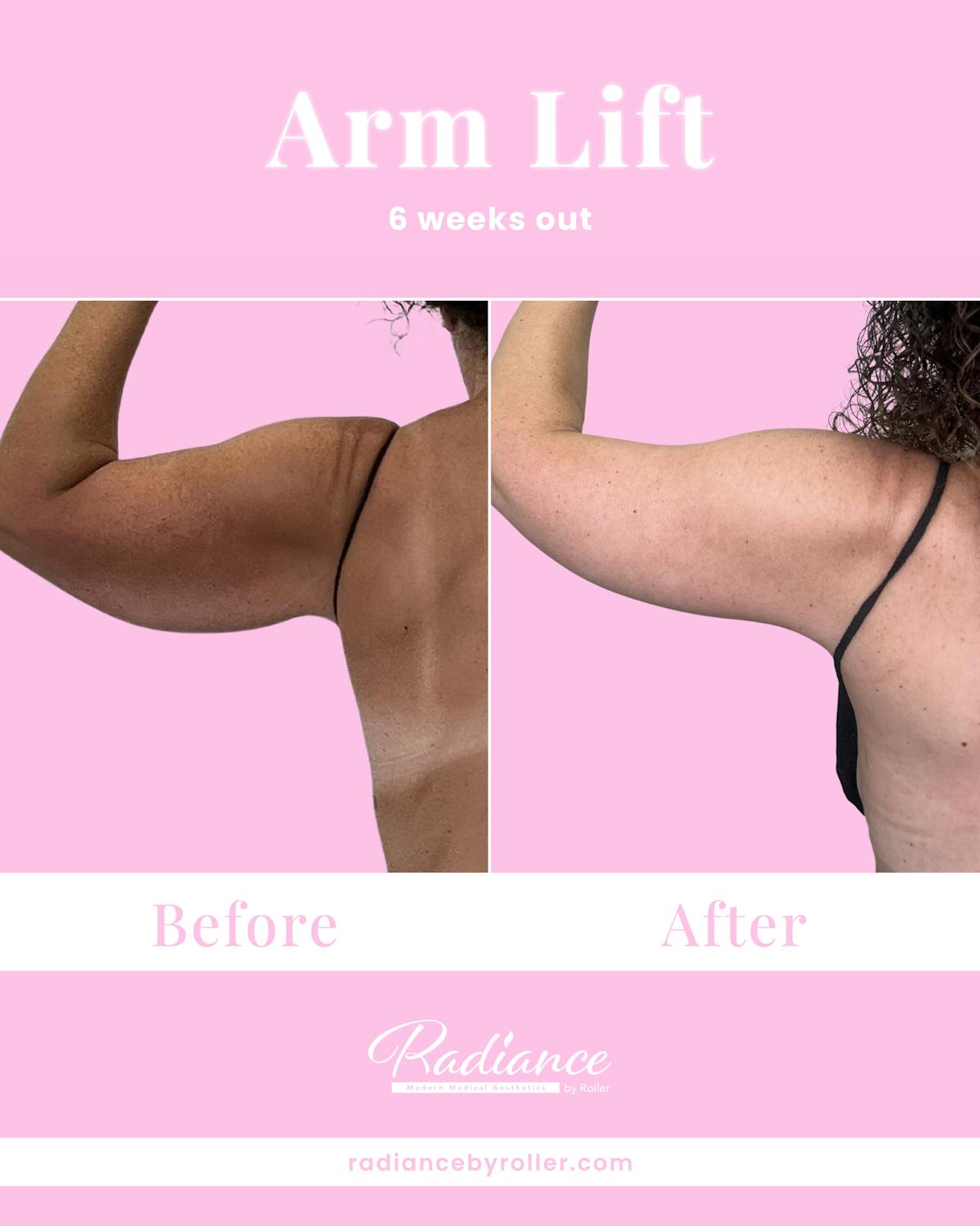 Arm Lift Before & After Gallery - Patient 211635 - Image 1