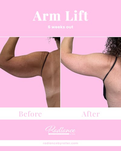 Arm Lift Before & After Gallery - Patient 211635 - Image 1