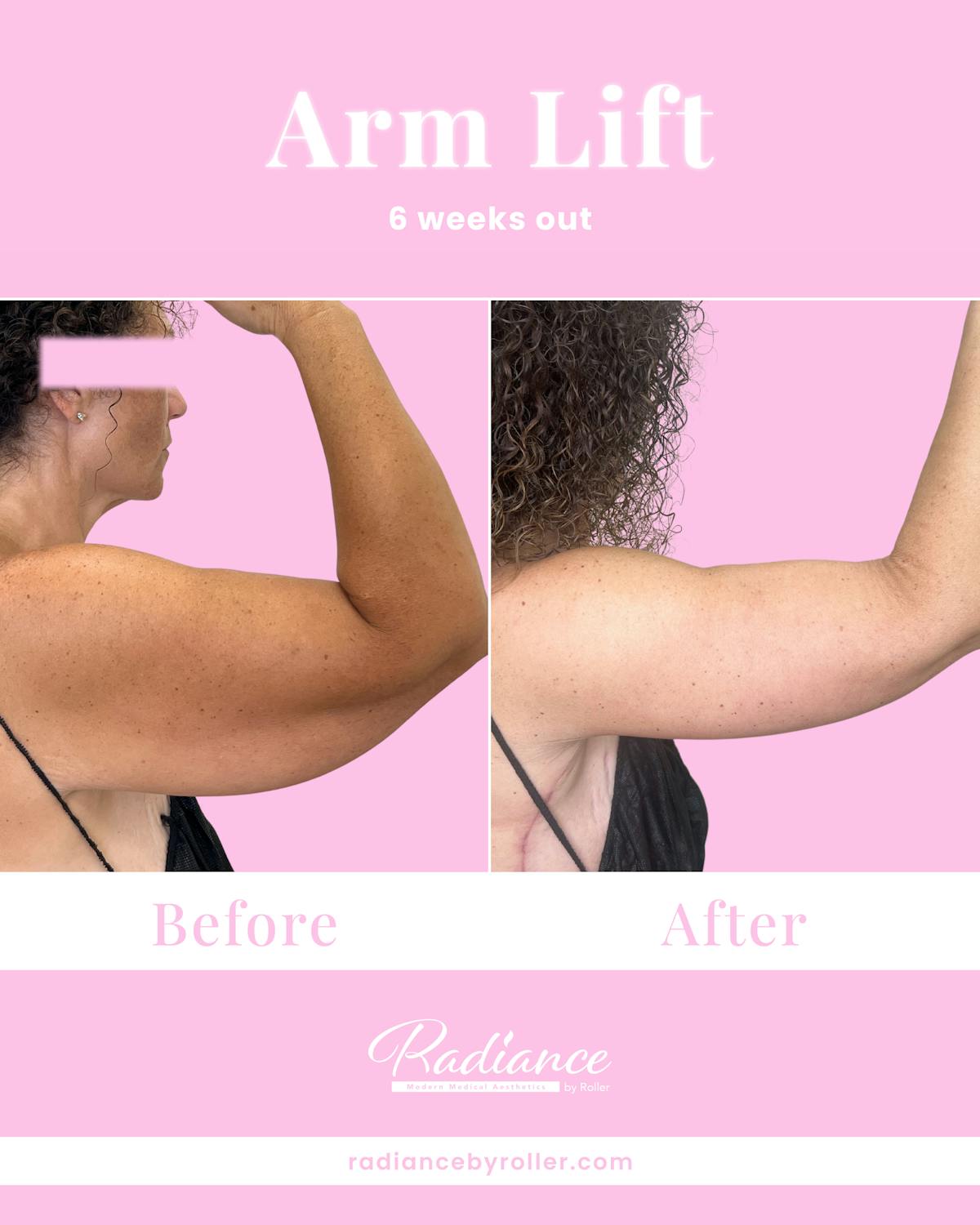 Arm Lift Before & After Gallery - Patient 211635 - Image 2