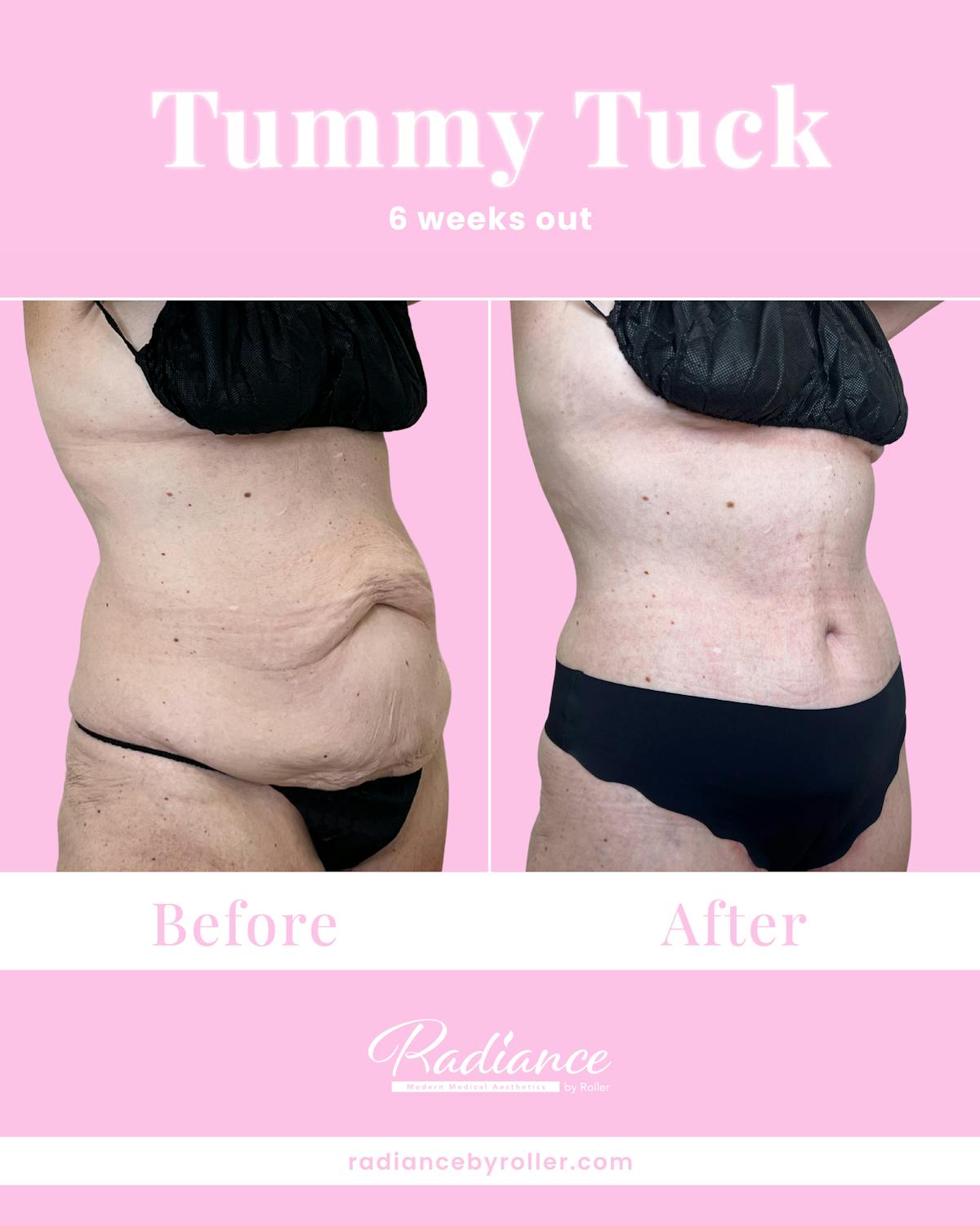 Tummy Tuck Before & After Gallery - Patient 933831 - Image 2