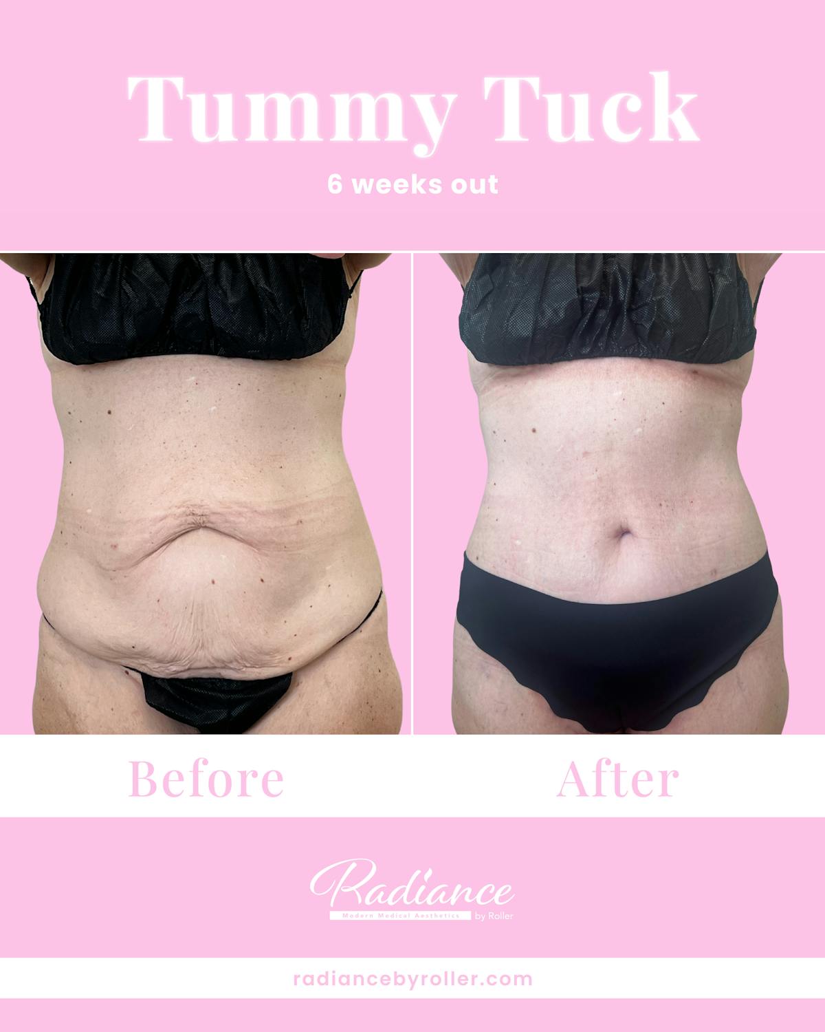 Tummy Tuck Before & After Gallery - Patient 933831 - Image 1